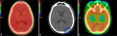 The Cognitive Effects of Radiotherapy for Brain Metastases